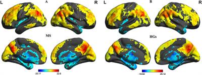 Relapsing-Remitting Multiple Sclerosis Is Associated With Regional Brain Activity Deficits in Motor- and Cognitive-Related Brain Areas